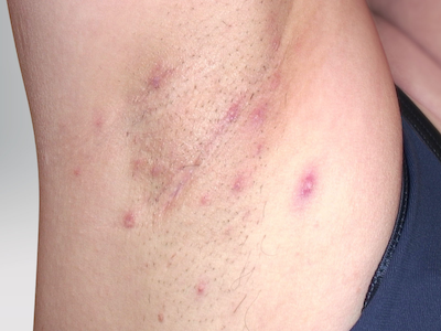 Hidradenitis suppurativa on armpit: Stage 2 (moderate)