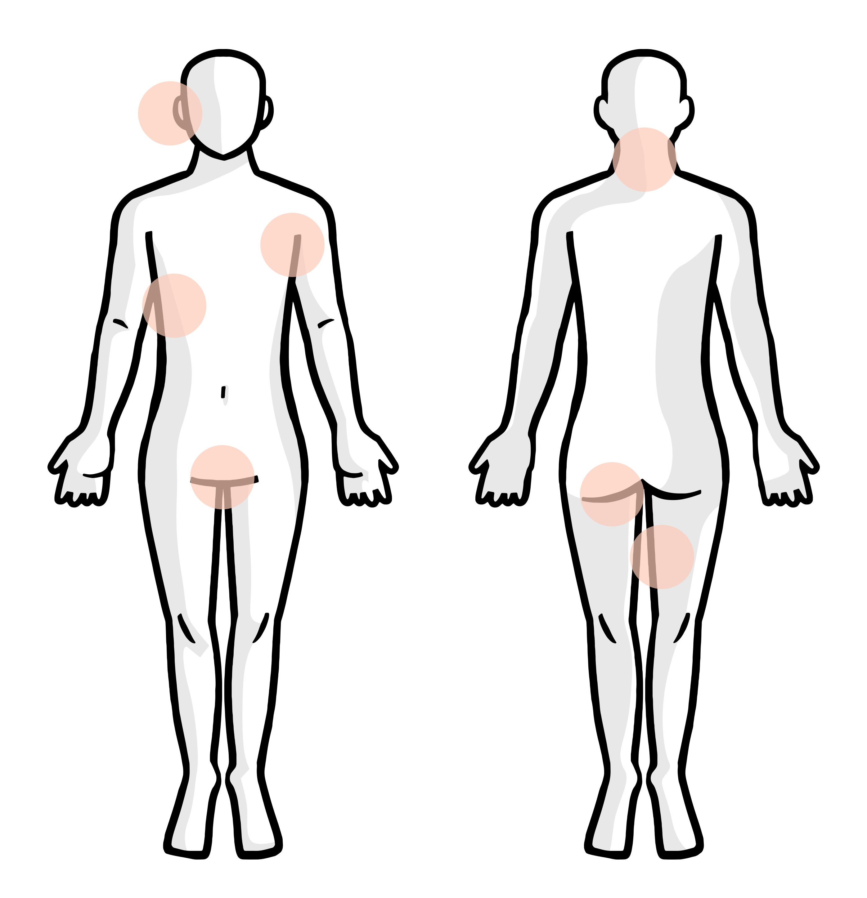Illustration of a body with highlights on areas affected by hidradenitis suppurativa