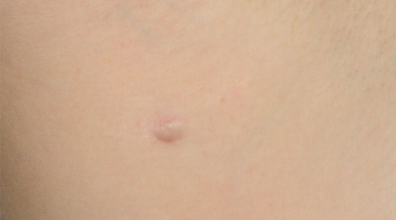 Hidradenitis suppurativa armpit: Stage 1 (mild)