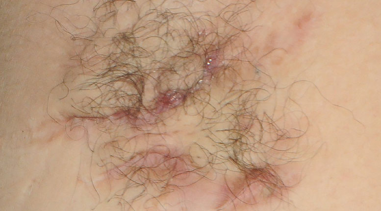 Hidradenitis suppurativa armpit: Stage 2 (moderate)