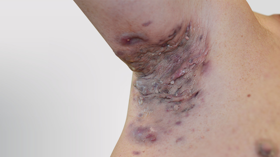 Hidradenitis suppurativa armpit: Stage 3 (severe)