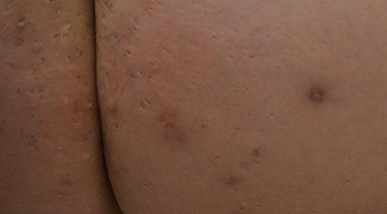 Ask a Dermatologist Online for Bumps On Inner Thigh Hurt