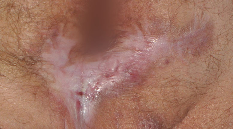 Hidradenitis suppurativa buttocks: Stage 3 (severe)