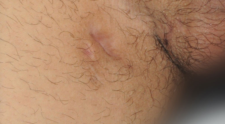 Hidradenitis suppurativa groin: Stage 1 (mild)