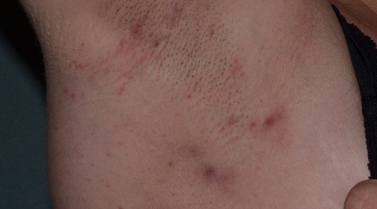 Hidradenitis suppurativa armpit: Stage 1 (mild)