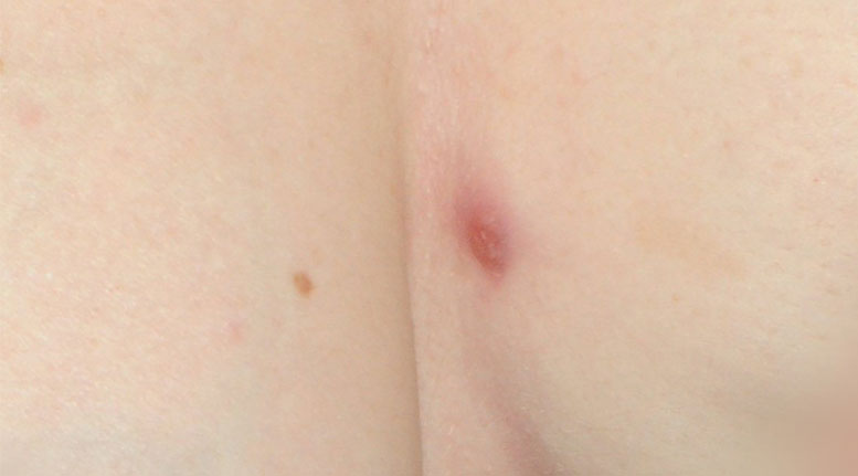 Hidradenitis suppurativa breast: Stage 1 (mild)