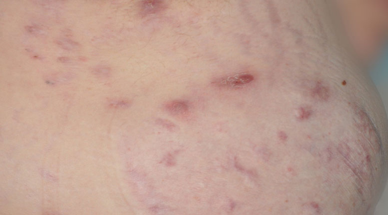 Hidradenitis suppurativa breast: Stage 2 (moderate)