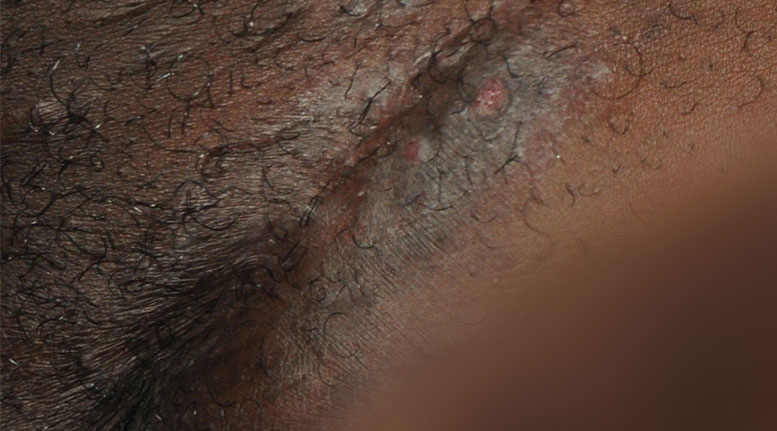 Hidradenitis suppurativa groin: Stage 1 (mild)